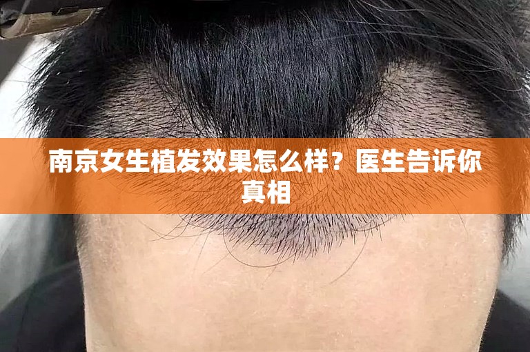 南京女生植发效果怎么样？医生告诉你真相