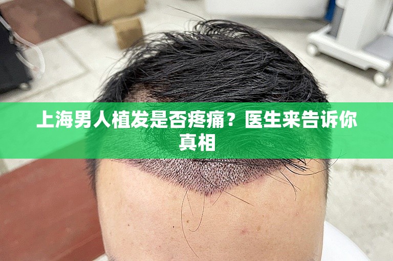 上海男人植发是否疼痛？医生来告诉你真相