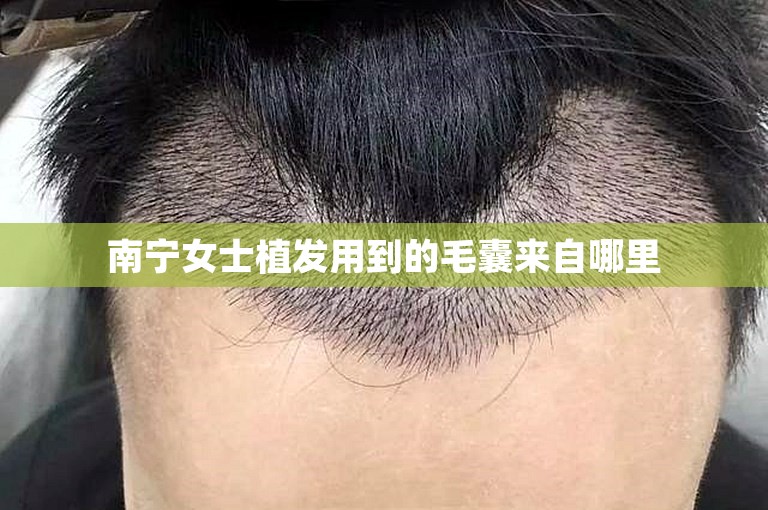 南宁女士植发用到的毛囊来自哪里