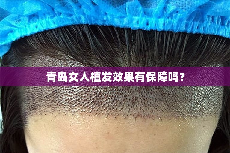 青岛女人植发效果有保障吗？