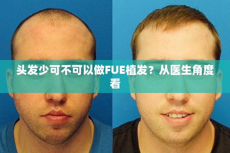 头发少可不可以做FUE植发？从医生角度看