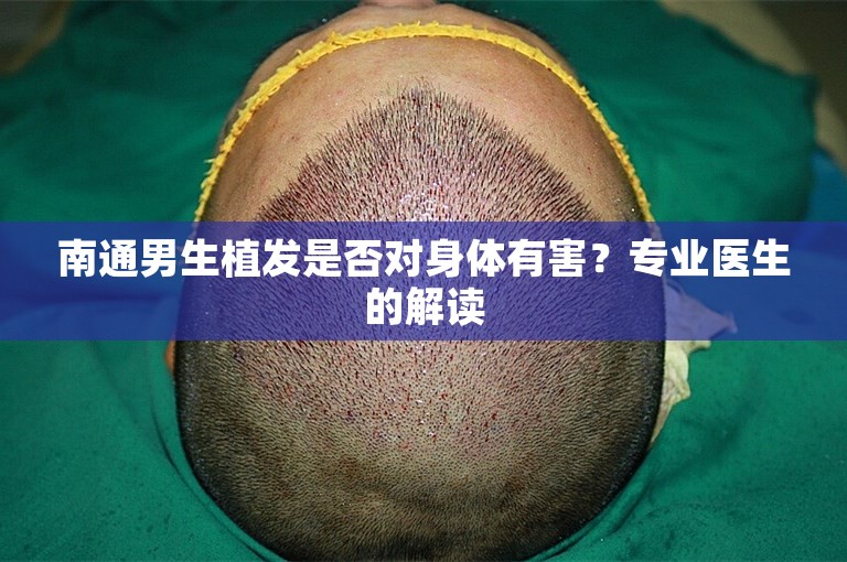 南通男生植发是否对身体有害？专业医生的解读