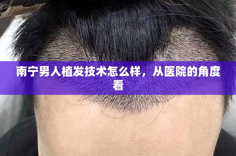 南宁男人植发技术怎么样，从医院的角度看