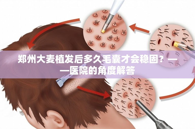 郑州大麦植发后多久毛囊才会稳固？——医院的角度解答