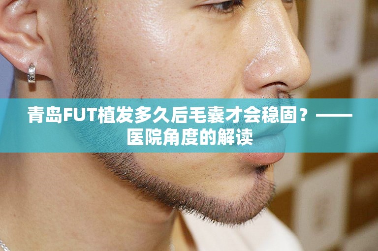 青岛FUT植发多久后毛囊才会稳固？——医院角度的解读