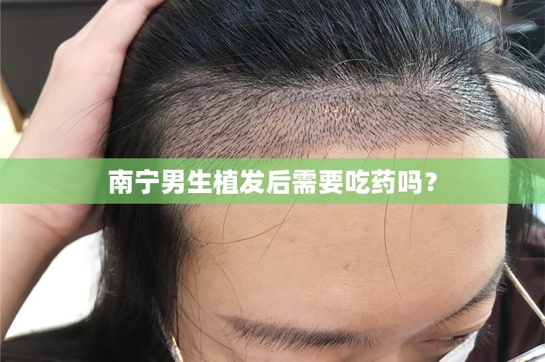 南宁男生植发后需要吃药吗？