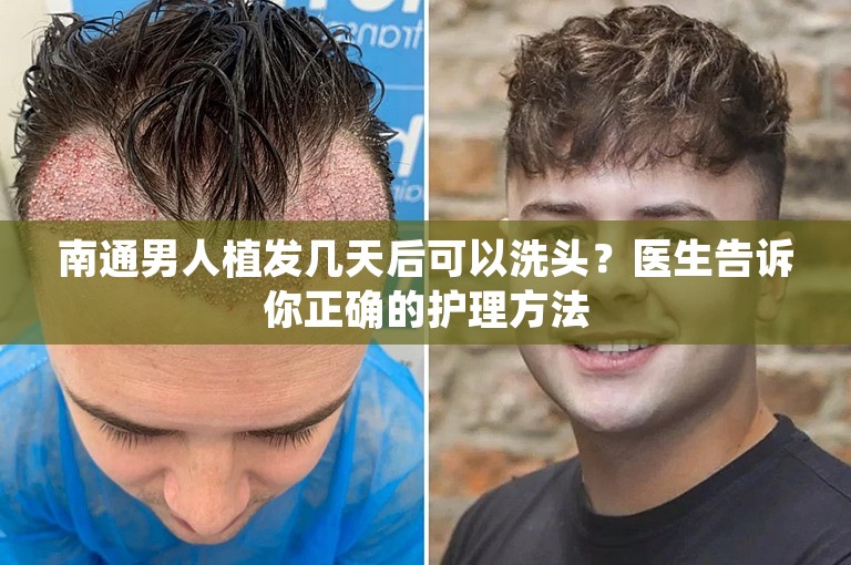 南通男人植发几天后可以洗头？医生告诉你正确的护理方法