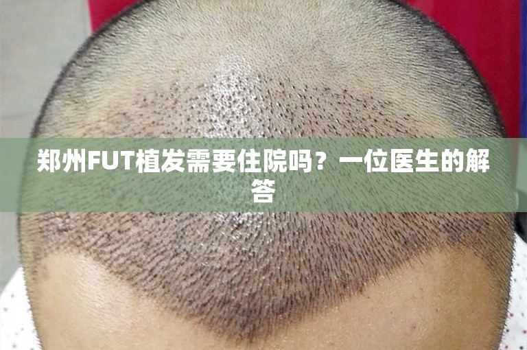 郑州FUT植发需要住院吗？一位医生的解答