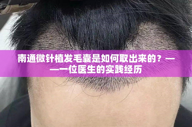 南通微针植发毛囊是如何取出来的？——一位医生的实践经历