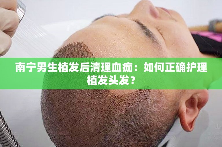 南宁男生植发后清理血痂：如何正确护理植发头发？