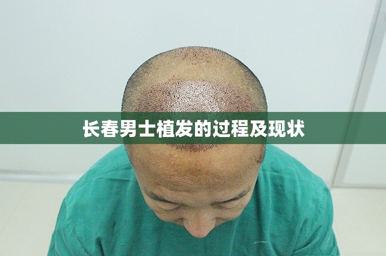 长春男士植发的过程及现状