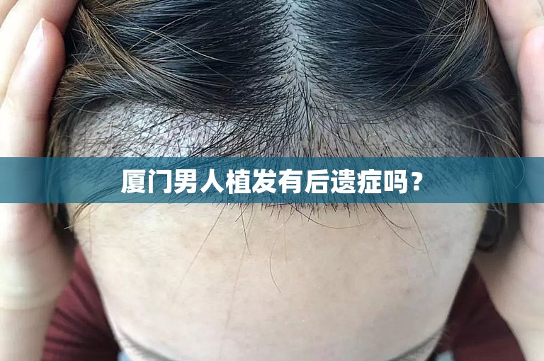 厦门男人植发有后遗症吗？