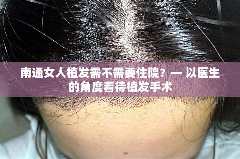 南通女人植发需不需要住院？— 以医生的角度看待植发手术