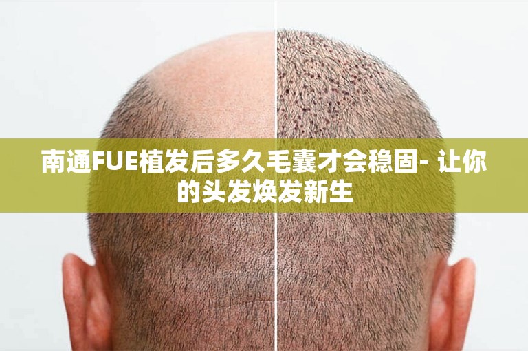 南通FUE植发后多久毛囊才会稳固- 让你的头发焕发新生