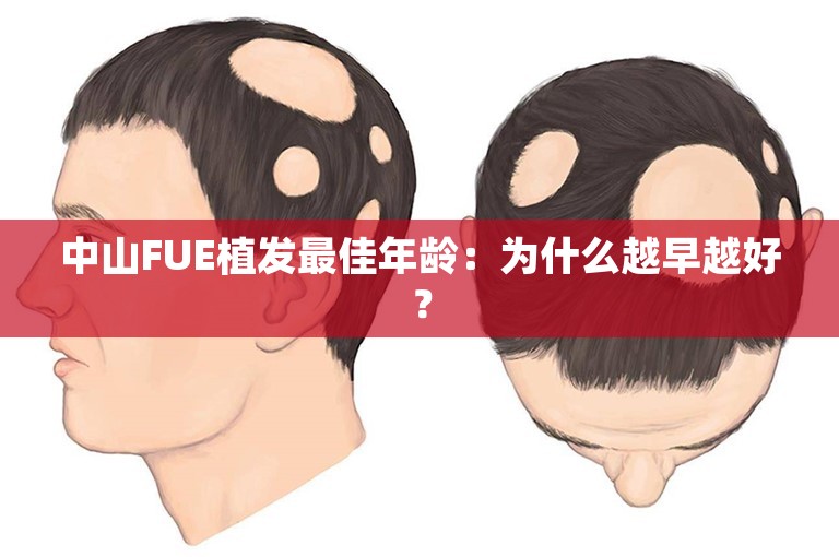 中山FUE植发最佳年龄：为什么越早越好？