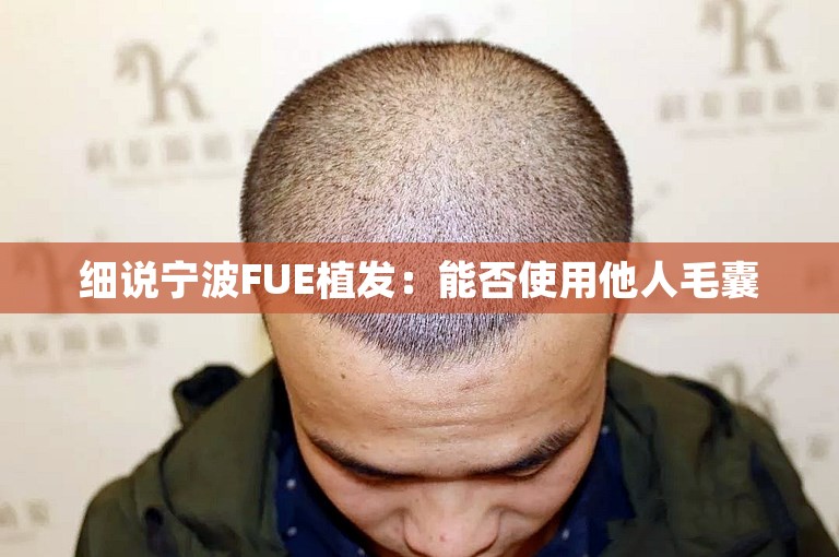 细说宁波FUE植发：能否使用他人毛囊