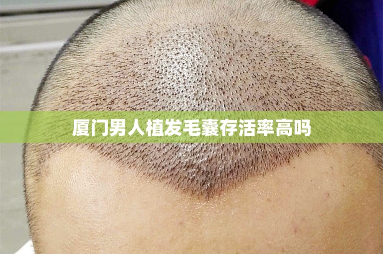 厦门男人植发毛囊存活率高吗