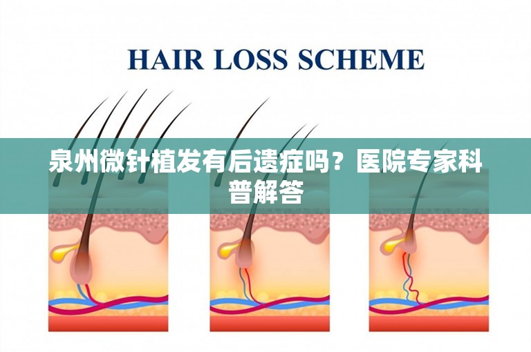 泉州微针植发有后遗症吗？医院专家科普解答