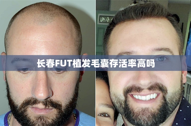 长春FUT植发毛囊存活率高吗