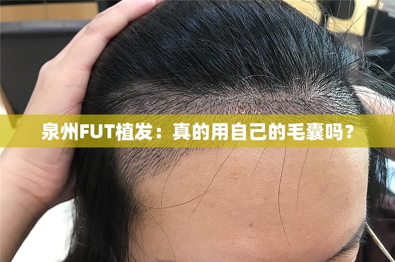 泉州FUT植发：真的用自己的毛囊吗？