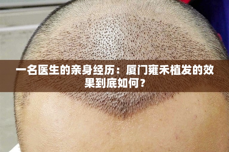 一名医生的亲身经历：厦门雍禾植发的效果到底如何？