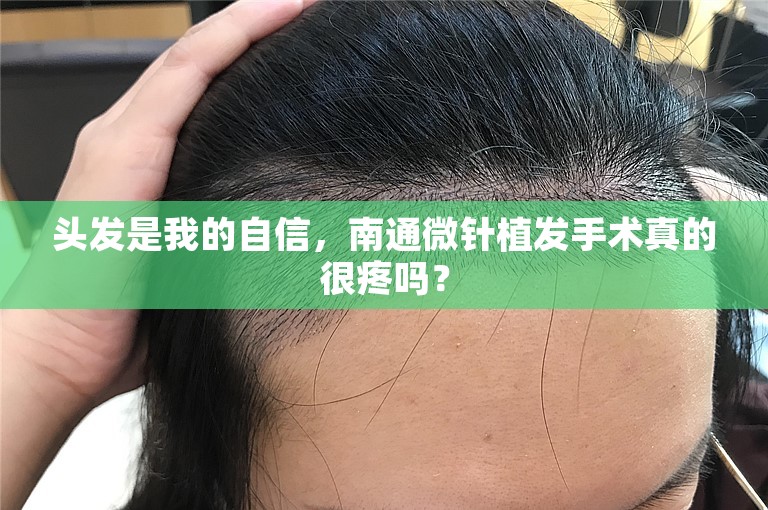 头发是我的自信，南通微针植发手术真的很疼吗？