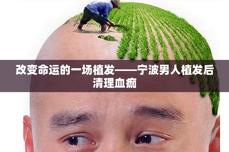 改变命运的一场植发——宁波男人植发后清理血痂