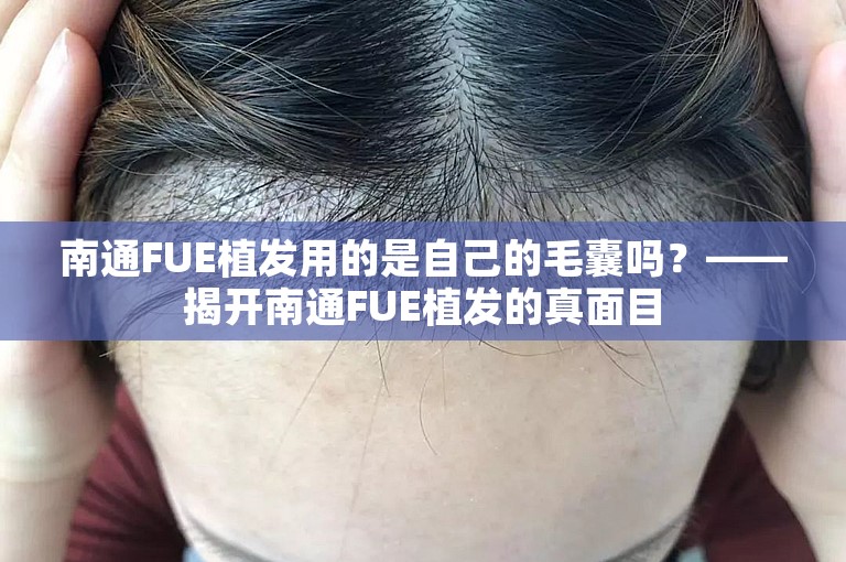 南通FUE植发用的是自己的毛囊吗？——揭开南通FUE植发的真面目