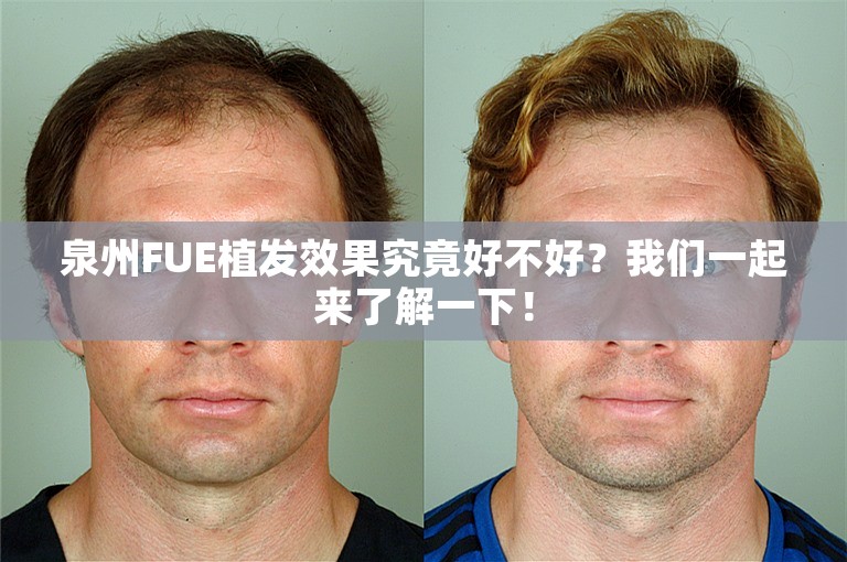 泉州FUE植发效果究竟好不好？我们一起来了解一下！