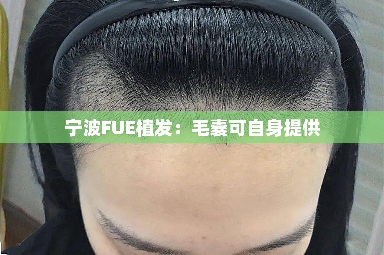 宁波FUE植发：毛囊可自身提供