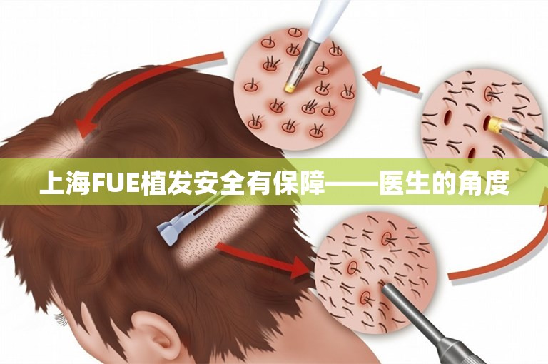 上海FUE植发安全有保障——医生的角度