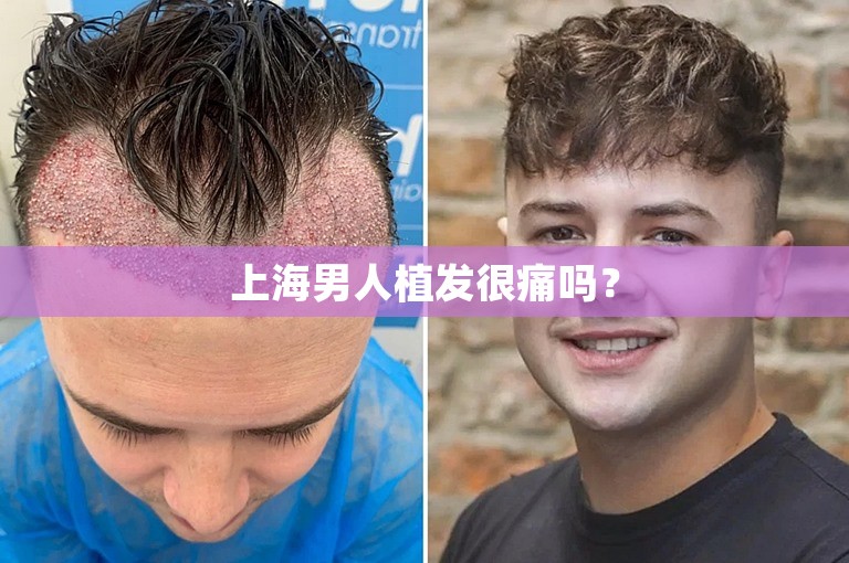 上海男人植发很痛吗？