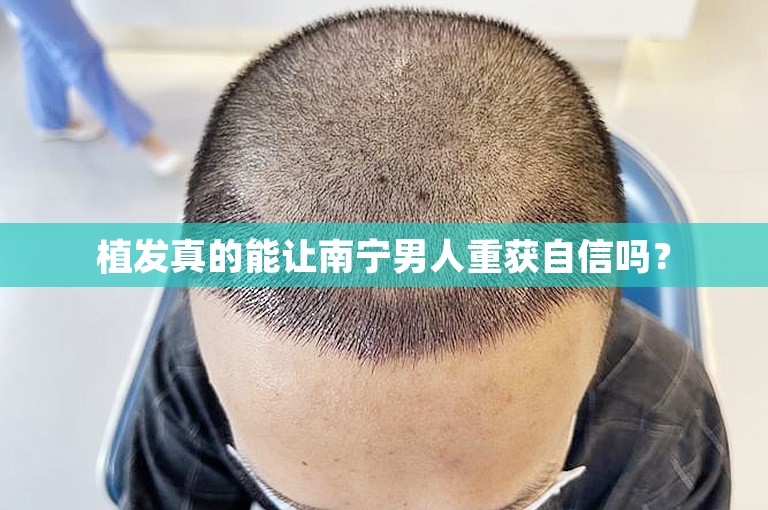 植发真的能让南宁男人重获自信吗？