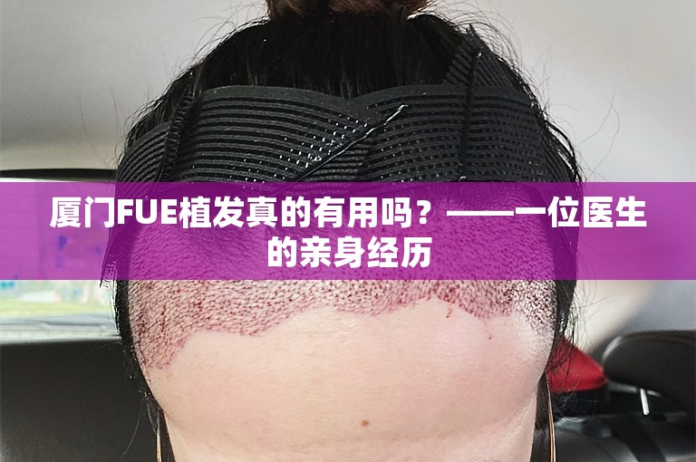 厦门FUE植发真的有用吗？——一位医生的亲身经历