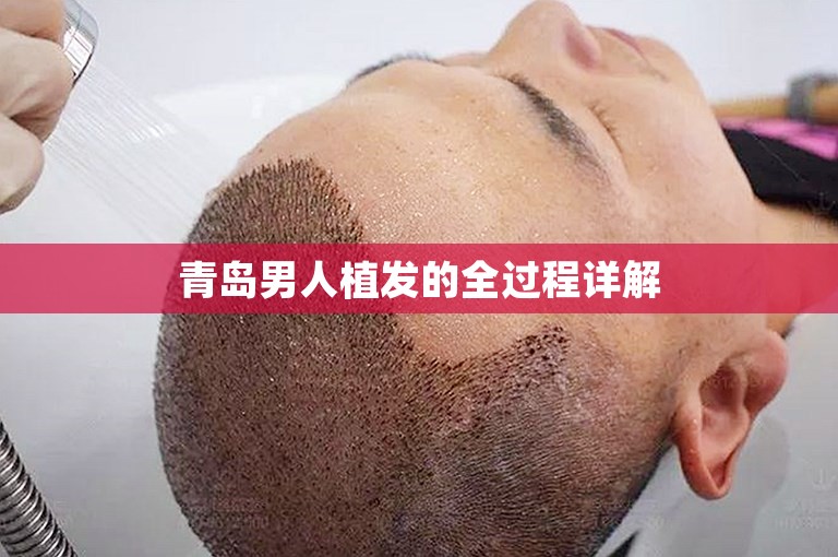 青岛男人植发的全过程详解