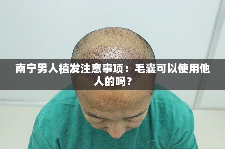 南宁男人植发注意事项：毛囊可以使用他人的吗？