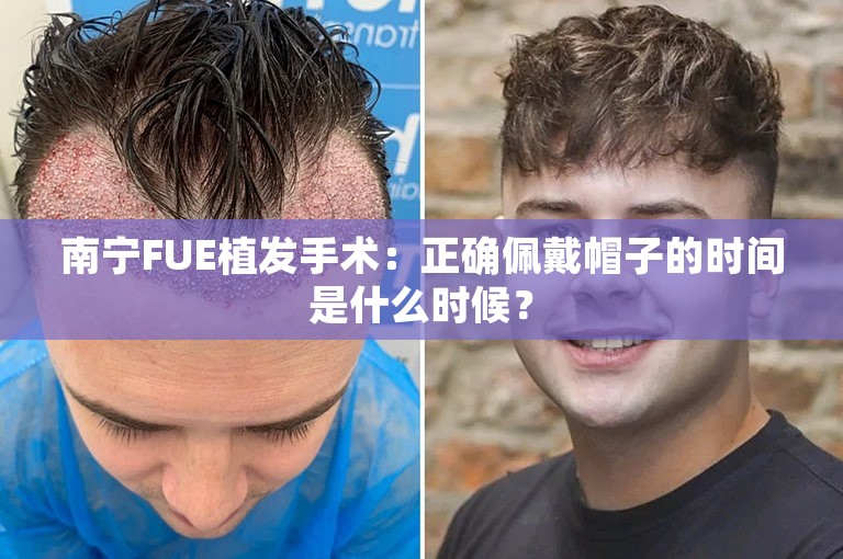 南宁FUE植发手术：正确佩戴帽子的时间是什么时候？