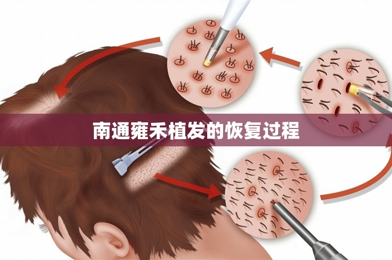 南通雍禾植发的恢复过程