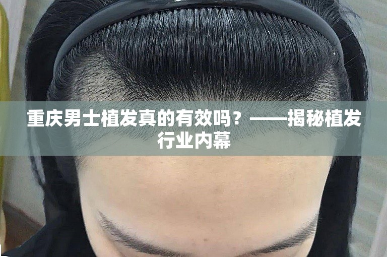 重庆男士植发真的有效吗？——揭秘植发行业内幕