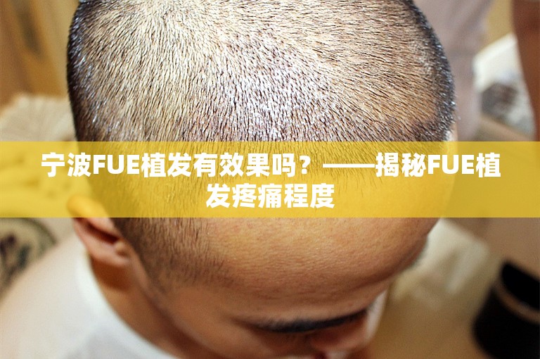 宁波FUE植发有效果吗？——揭秘FUE植发疼痛程度