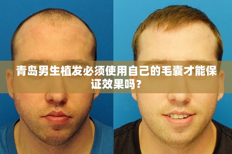 青岛男生植发必须使用自己的毛囊才能保证效果吗？