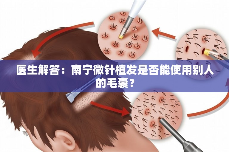 医生解答：南宁微针植发是否能使用别人的毛囊？