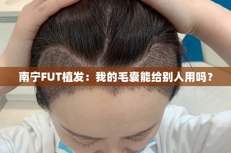 南宁FUT植发：我的毛囊能给别人用吗？