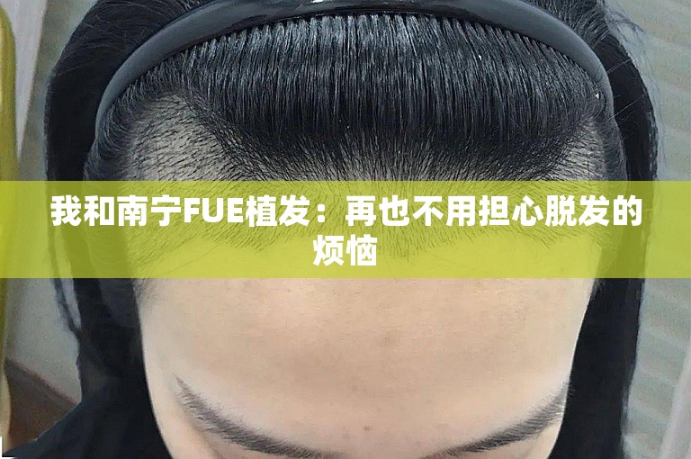 我和南宁FUE植发：再也不用担心脱发的烦恼