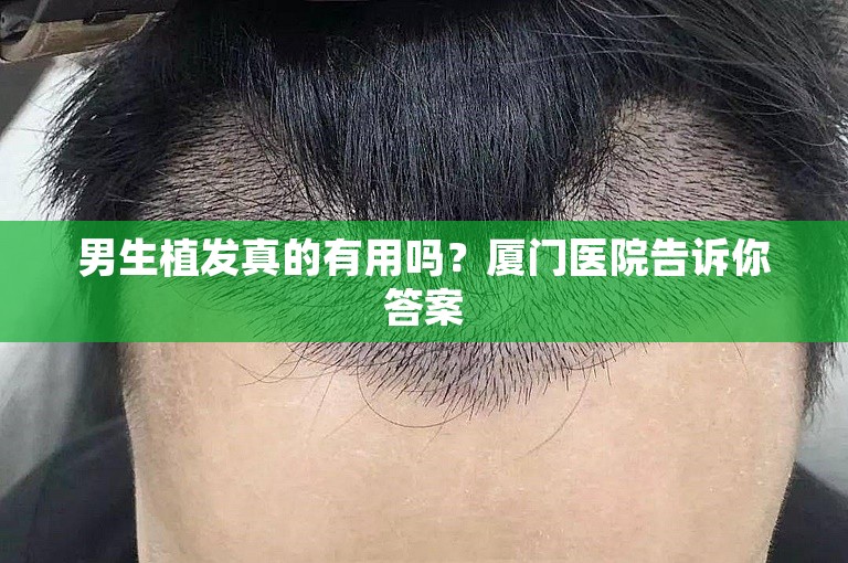 男生植发真的有用吗？厦门医院告诉你答案