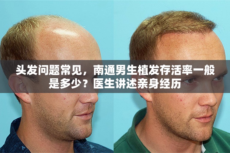 头发问题常见，南通男生植发存活率一般是多少？医生讲述亲身经历