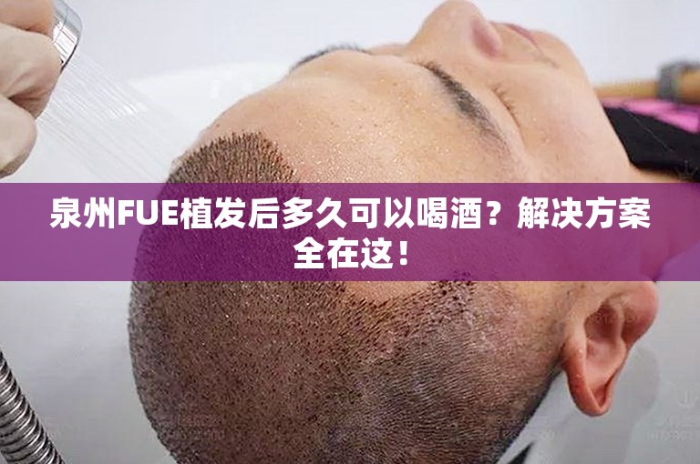 泉州FUE植发后多久可以喝酒？解决方案全在这！