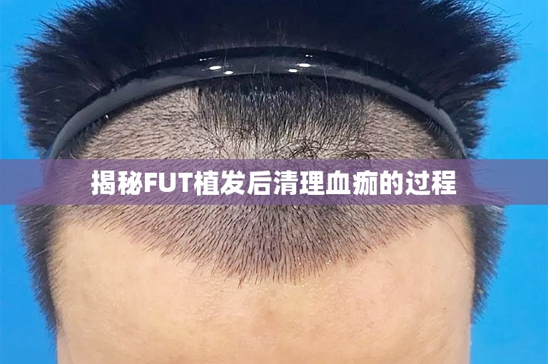 揭秘FUT植发后清理血痂的过程