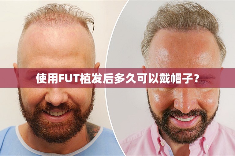 使用FUT植发后多久可以戴帽子？