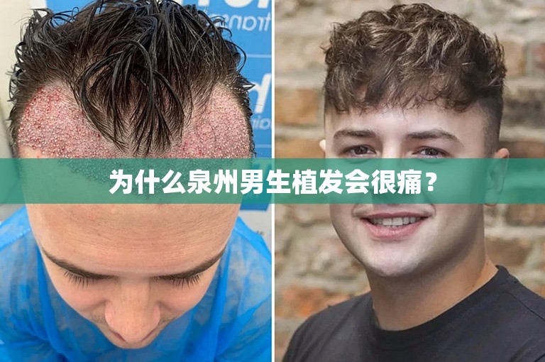 为什么泉州男生植发会很痛？